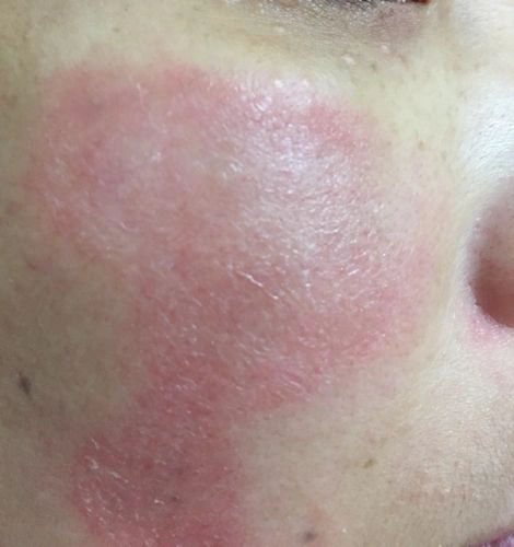 过敏怎么处理如何快速消退过敏反应