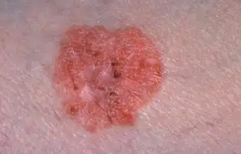 皮肤癌早期症状图片大全