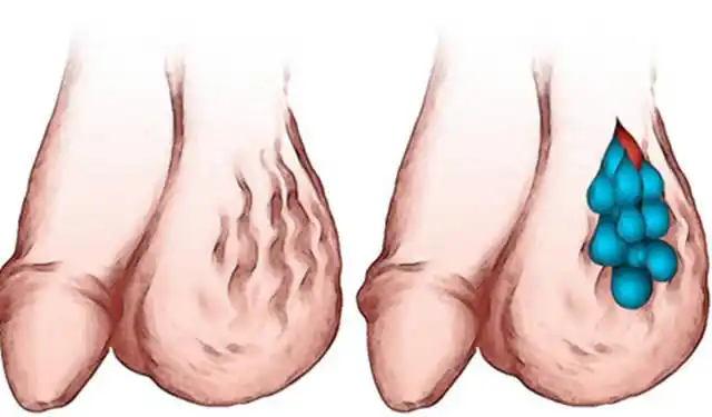 大家都较为熟知,但你知道吗,其实男性的蛋蛋上也会出现这种形似蚯蚓状