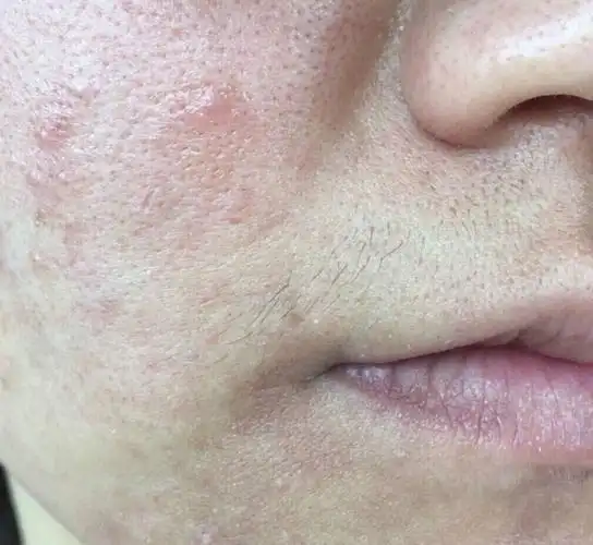 角质层的屏障损伤