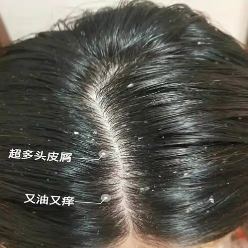 头皮痒什么洗发水好用?洗发水去屑止痒推荐_头发_成分