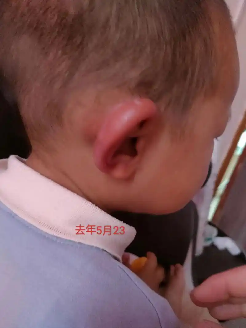 年年五月份耳朵肿成图图,也不知道是过敏还是虫咬的, - 抖音