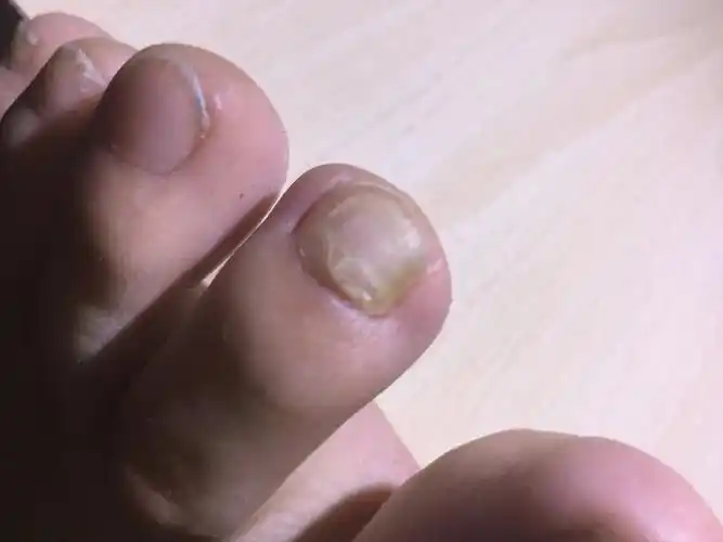 17岁,高中生,一两周前发现左脚中指有异常,不会是灰指甲吧?