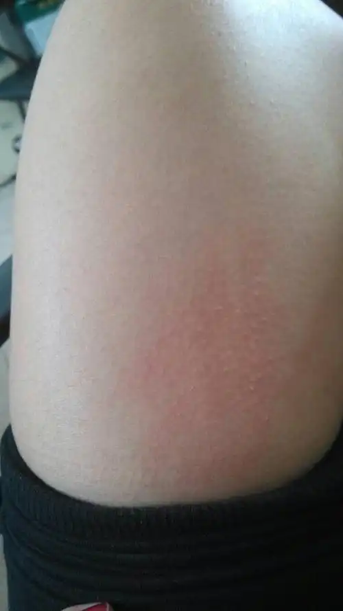 大腿内侧有两个疙