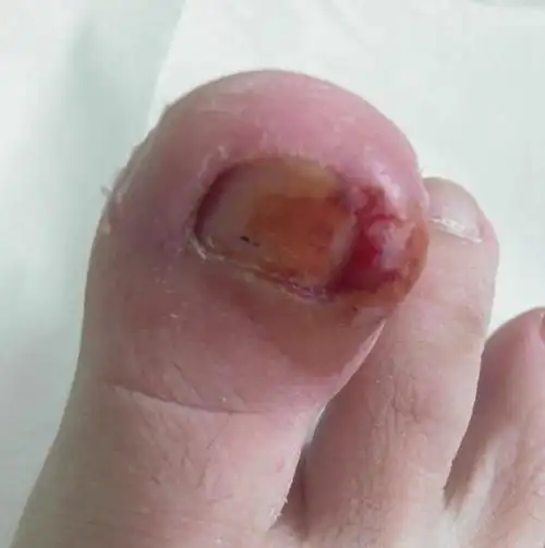 甲沟炎的诊断和鉴别甲周炎的图片