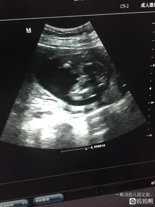 医学上讲在怀孕20周四个月左右做b超检查时就很容易就能看出胎儿性别