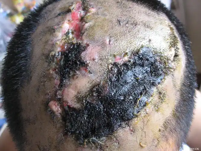 患者外伤后头皮撕脱伤4天,目前头顶皮肤大片坏死,下一步怎样治疗?