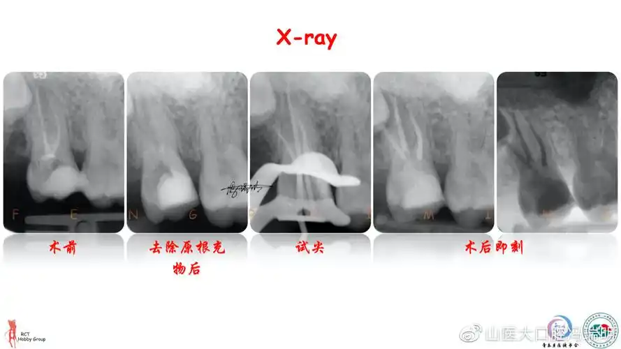 上颌第二磨牙根管解剖形态特点及病例分享
