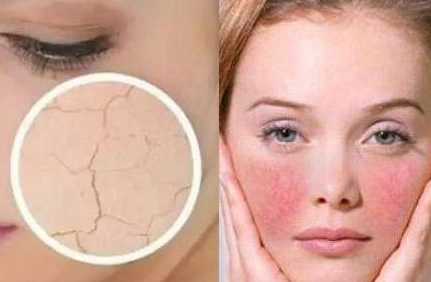 角质层过薄怎么办角质层太薄怎么修复