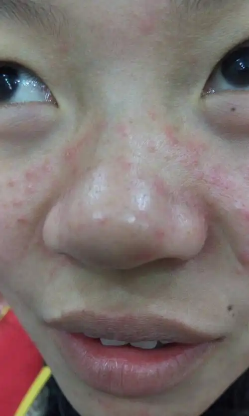 最近从南方转到北方工作,脸上开始长痘痘,不疼,也不痒,吃些过敏药会好