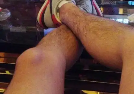 为何有的男性腿毛旺盛,有的却很"光滑"?腿毛少意味着什么?