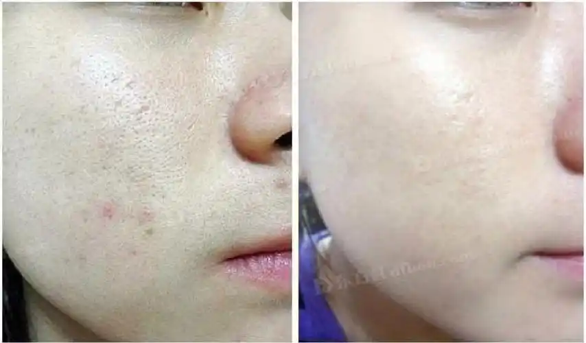 毛孔粗大怎么办  #收缩毛孔  ##能收缩毛孔的精华  #收缩毛孔  #毛孔