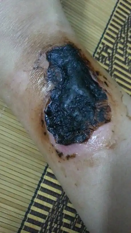 这个疤什么时候才会彻底的掉完啊?怎样处理才好的快而且不留疤