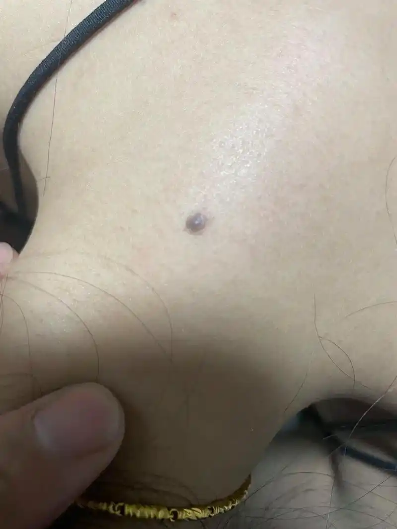 大家帮忙看看我的痣,长在后脖子中间 ,用不用去除?#黑色素痣 - 抖音