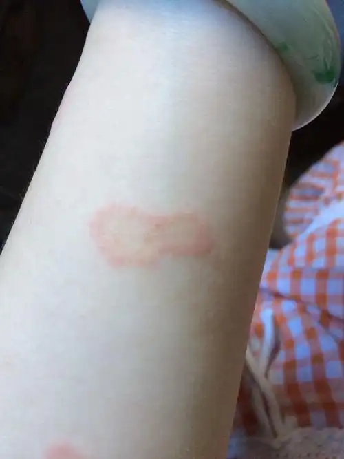 手臂上突然起了这样的苞,是怎么回事呢?