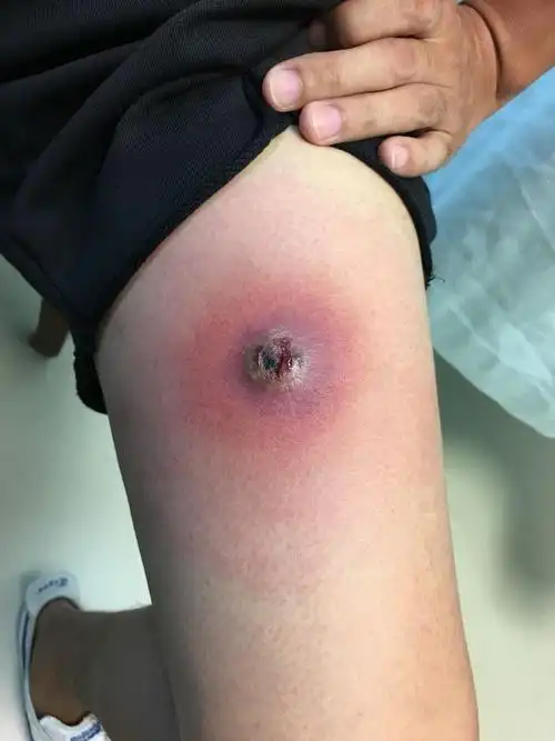 皮肤的细菌感染这种小的疖肿或者叫毛囊炎.