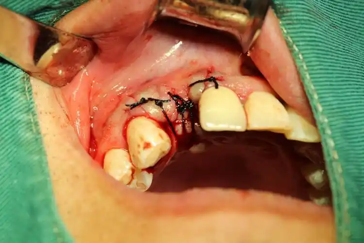 一例前牙美学区种植 写美篇术中患者无任何不适,并且手术时间短质量高