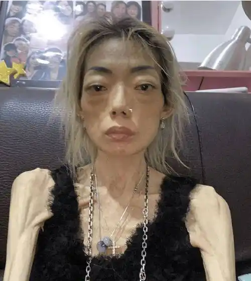 女星瘦起来能有多可怕有人瘦到icu抢救有人瘦到牙齿脱落