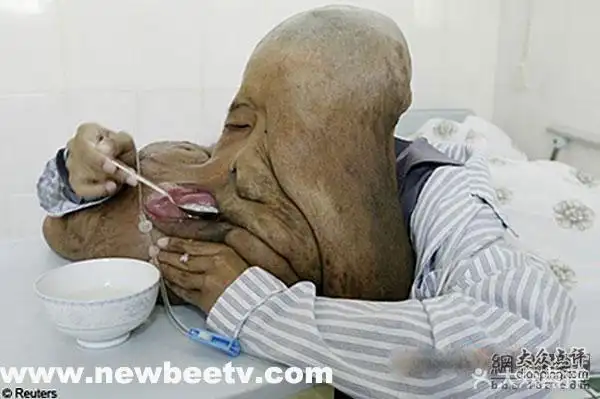 世界上恐怖的怪病(慎入)