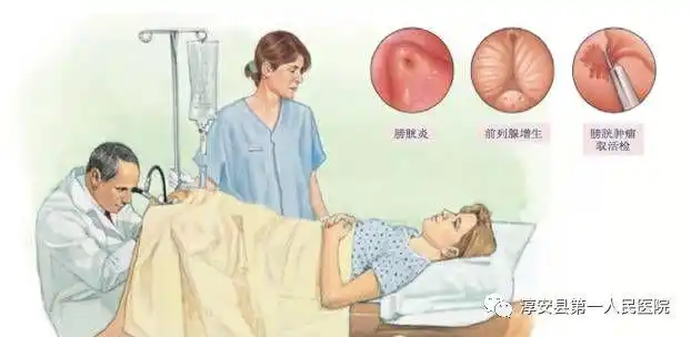 泌尿外科医生的"第三只眼睛"——膀胱镜_镜检查