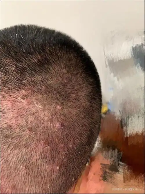 头上长痤疮怎么办 头皮长痘,暴露了生活中的哪些问题?