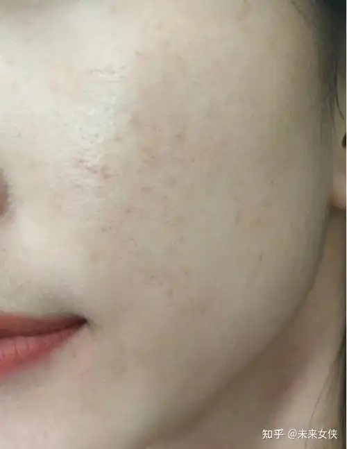 毛孔粗大真的不可逆吗刷酸能收缩毛孔吗