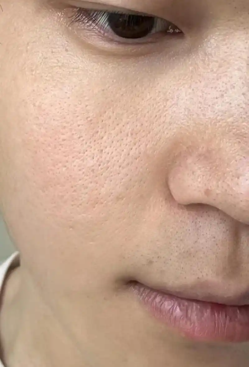 粗大的毛孔不仅会影响肌肤的光滑度和细腻度,还容易积聚污垢和油脂