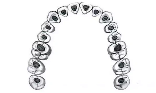 上颌第一磨牙根管治疗流程