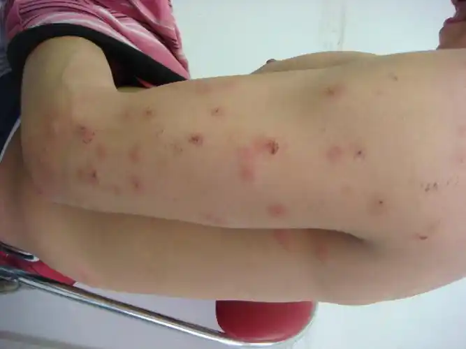 物理性皮肤病图片_物理性皮肤病症状表现图片大全_有来医生