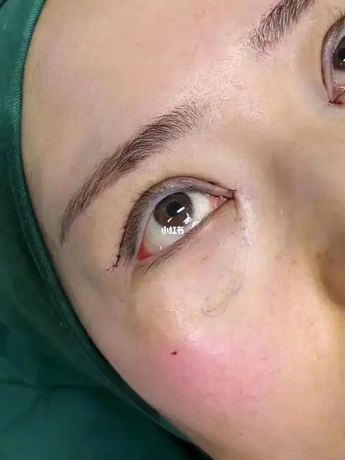 眼窝填充_华山名邸攻略_脂肪填充_脂肪填充眼窝_美妆_医美整形