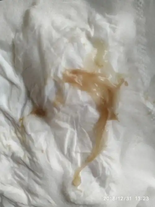 一是生理性,二是病理性生理性的白带褐色常见于两次月经的中期,为排卵