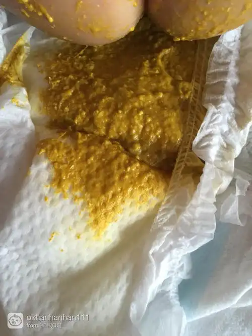 女宝五个半月 添加奶粉一个多月 便便里一直有这样小块 是奶瓣吗 需要