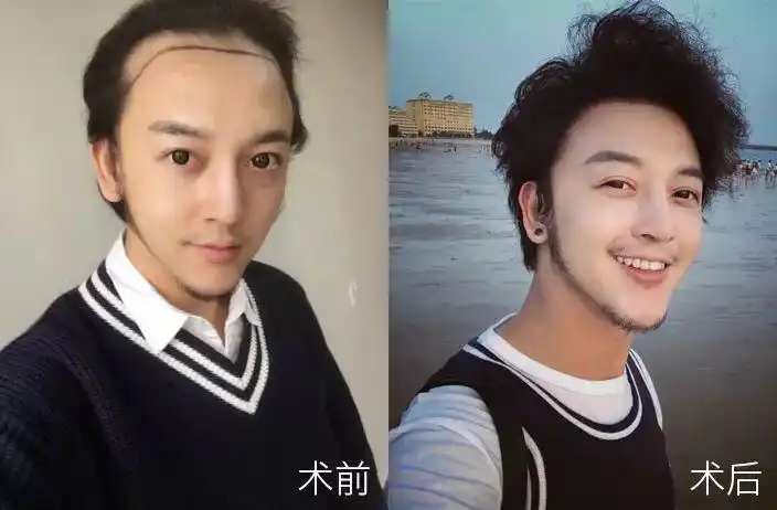 明星主播柳岩植发11个月!效果好到飞起好友也要来植发