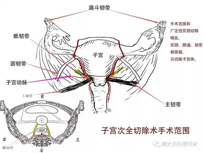 关于子宫切除的小秘密(一)——切除范围