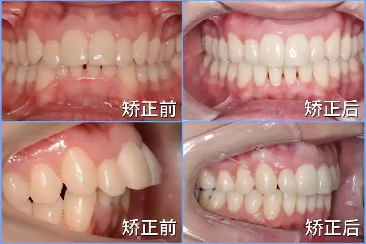 矫正前后口内像对比