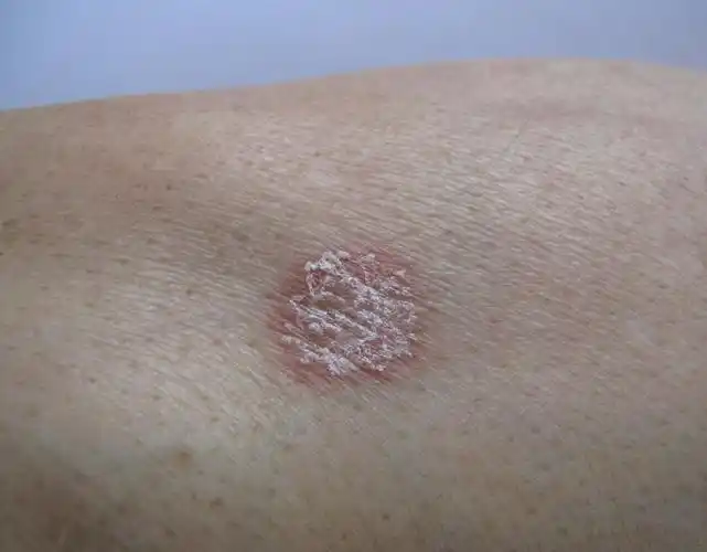 老年人皮肤病 - 皮肤及性传播疾病讨论版 - 爱爱医医学论坛