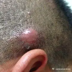 笔者于30多年的临床实践中应用此药治疗疖肿,湿疹