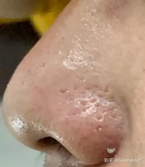 我这毛孔还有救吗.