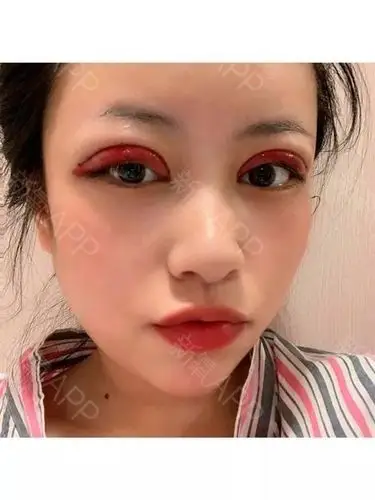 欧式芭比双眼皮787878 看下我的术后照片,o_圈子-新氧美容整形