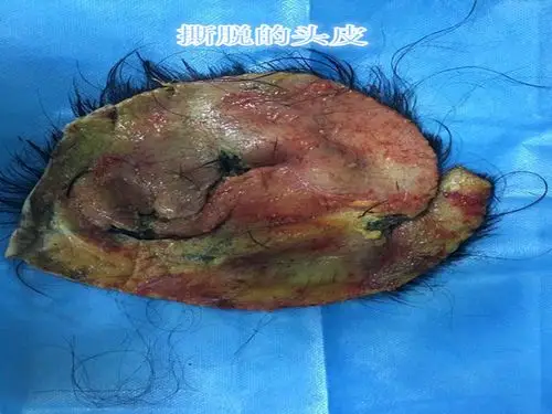 头皮完全撕脱危重病人获重生