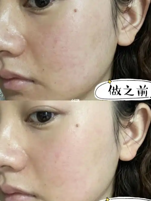 光子嫩肤一周|有图有真相_光子嫩肤_红血丝_万达广场(马鞍山路店)自由