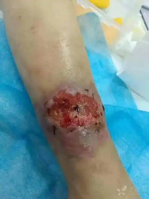 可怜的孩子皮肤已经开始溃烂了
