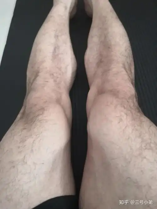 男生腿毛浓密怎么办