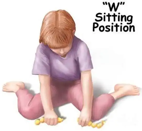 孩子平时如果经常采用跪坐的姿势,即w坐姿,会导致股骨内旋加重,如下图