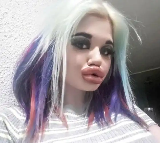 保加利亚少女想要世界最大嘴唇,丰唇20次大到合不上,仍不满足_腾讯