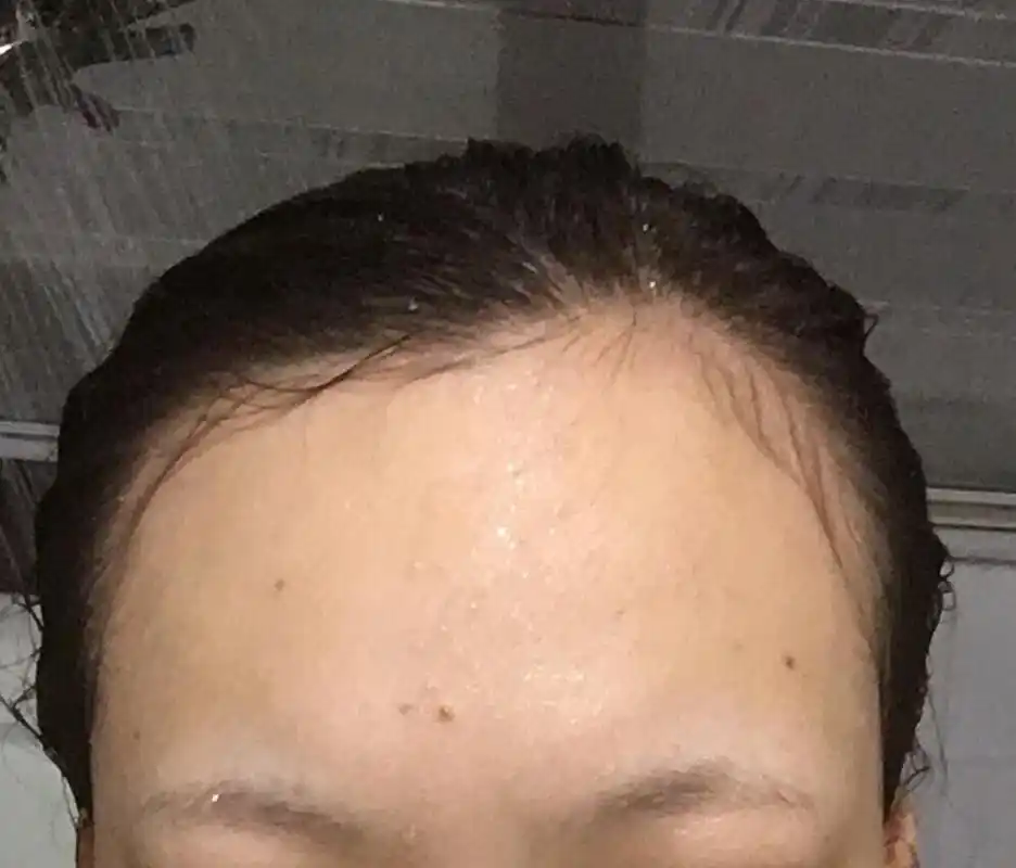 天生发际线高额头高,用那些生发的东西是不是都没.