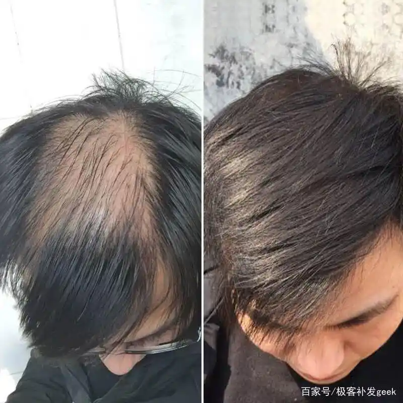 生发对比图是真实的吗?