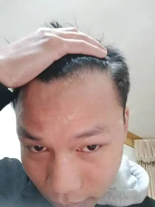 更美用户x0etcvlvji的植发际线日记