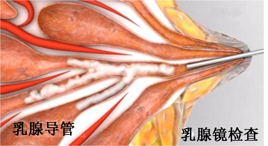 乳头溢液乳管镜检查