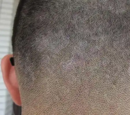 我头皮这是头癣吗